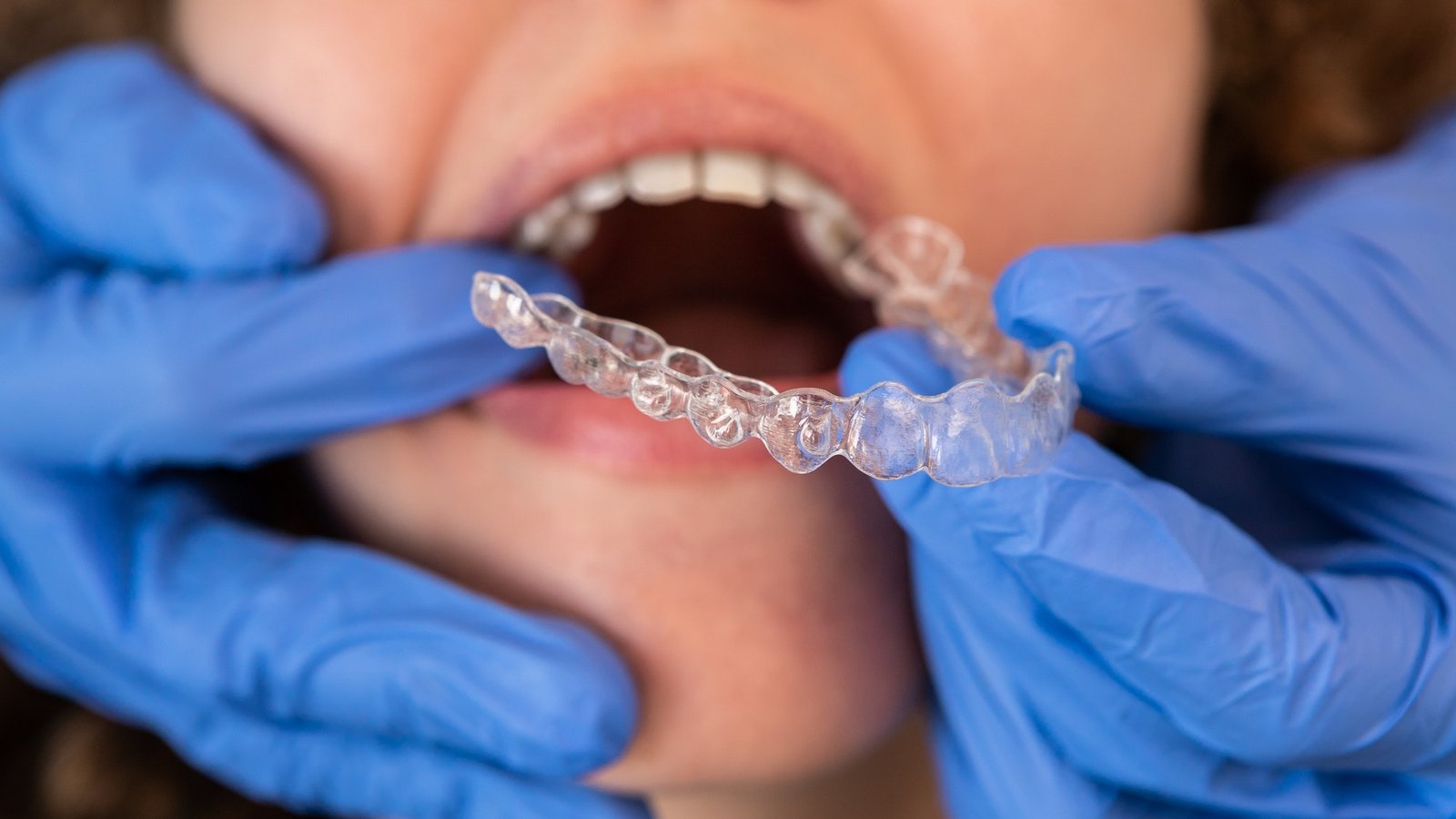 Orthodontic specialist adjusting and placing invisible aligners on woman